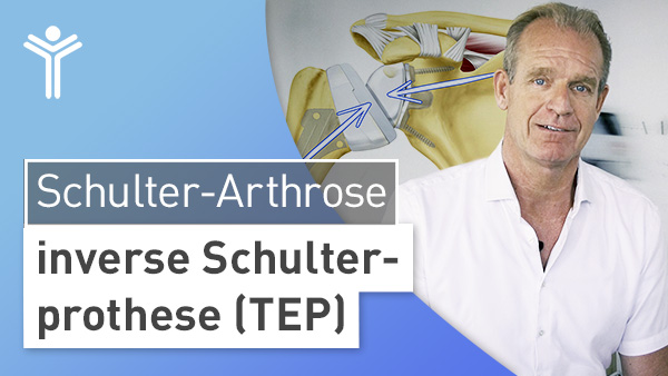 Schulter-Arthrose - inverse Schulterprothese (TEP)