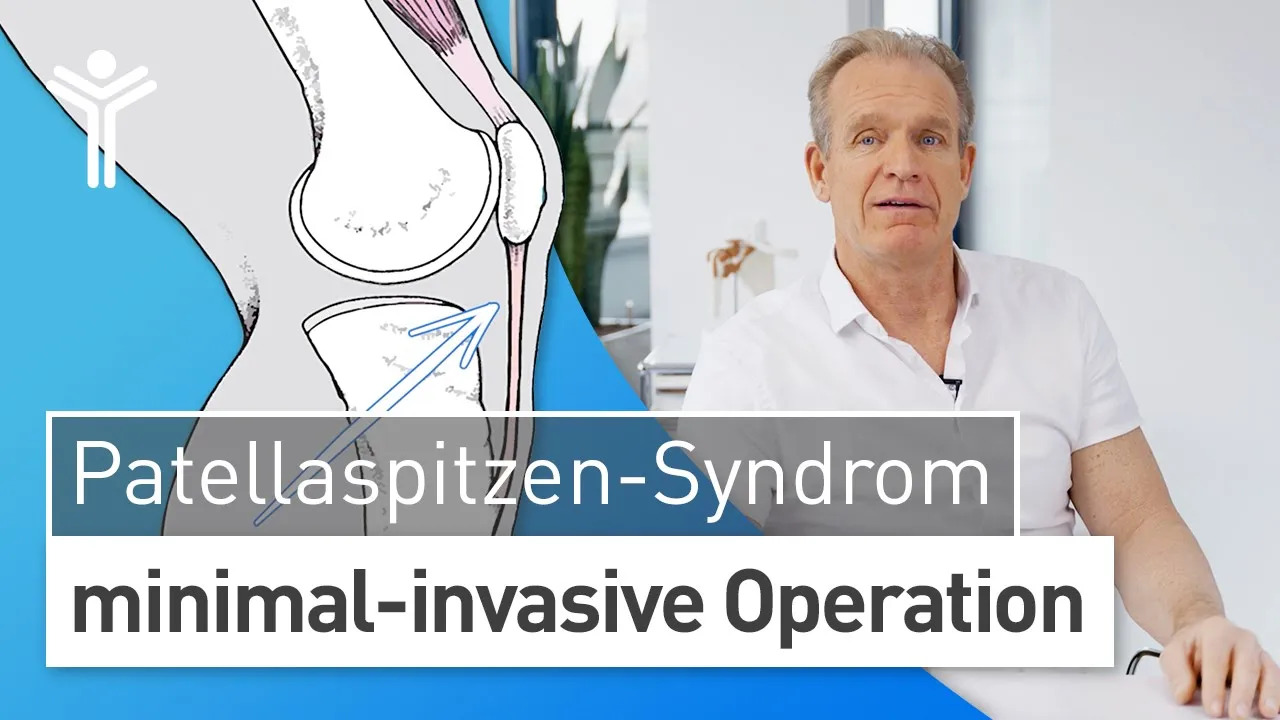 Patellaspitzen-Syndrom - minimal-invasive Operation