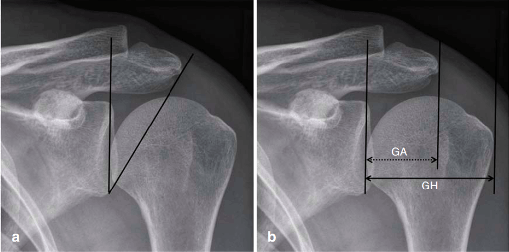 Impingement Syndrom Schulter Ausg 13 Klinik Am Ring