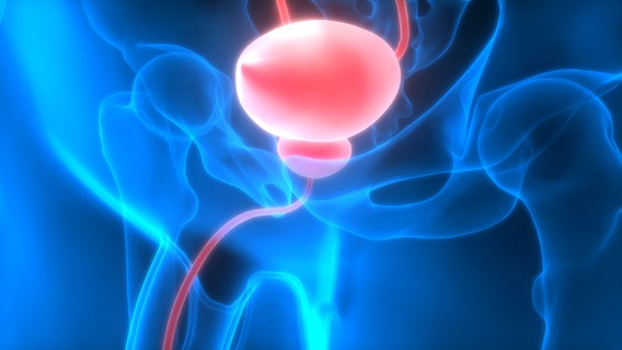 Avoiding Incontinency: Brachytherapy favours Prostatectomy